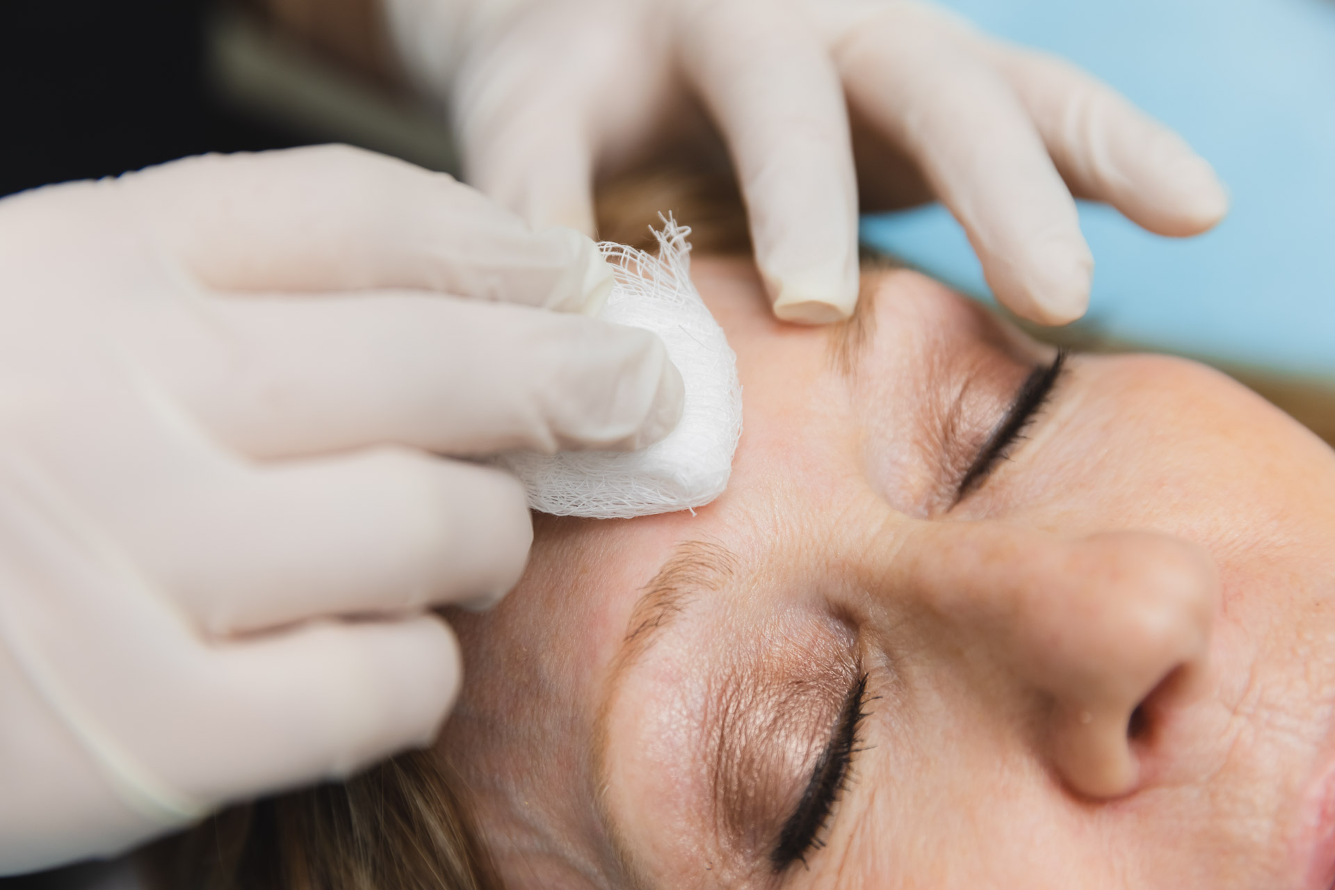 Close-up of a female patient receiving a chemical peel for age spot removal near Minnetonka