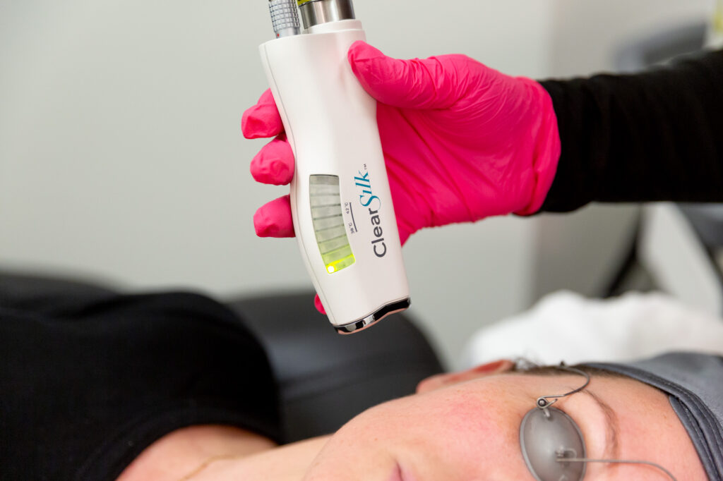 photo of procedure for a ClearSilk laser facial in Wayzata