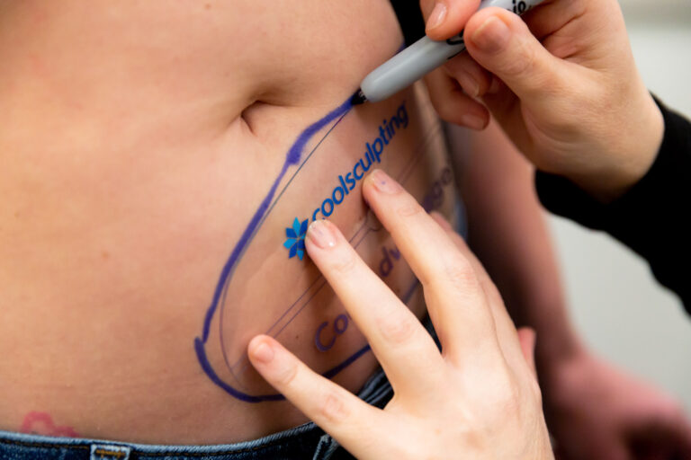 Provider drawing on patient's stomach in preparation for body sculpting near Minneapolis.