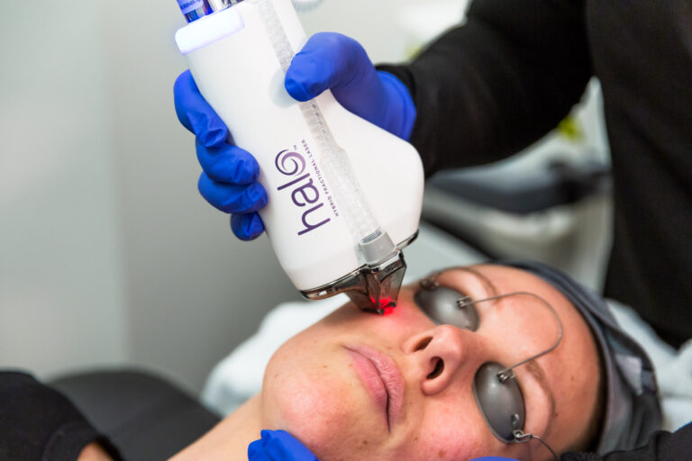 Close-up of a patient wearing protective eyewear while receiving HALO laser skin resurfacing near Eden Prairie, MN