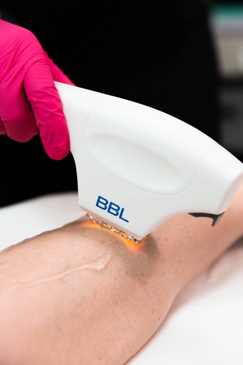 Laser Hair Removal Near Me Vively Body Science In Wayzata