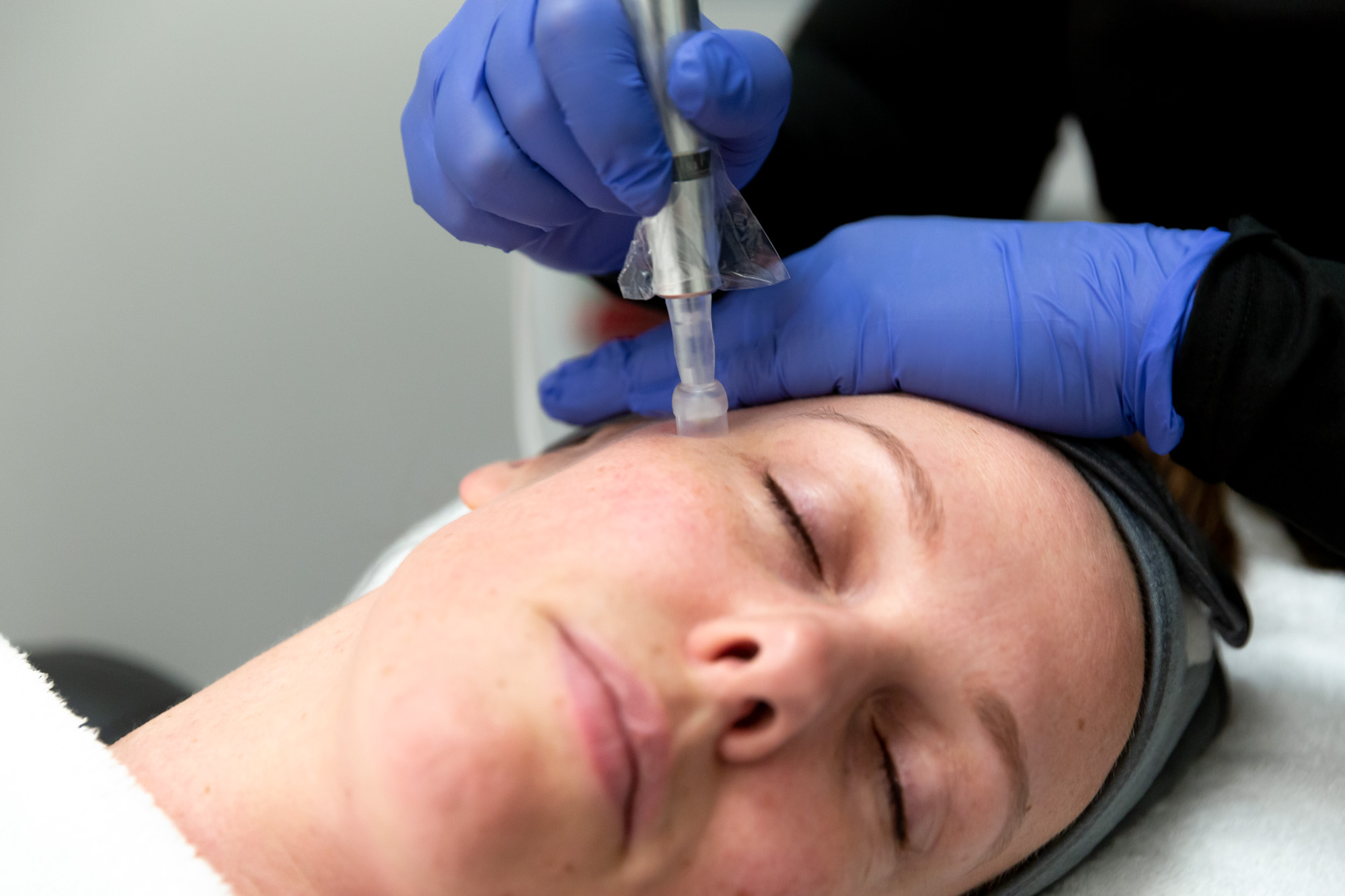 young woman provider in blue gloves having microneedling as one of the medical facials near me in Plymouth, MN