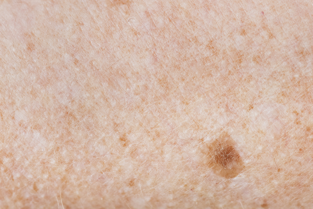 close up of skin with a freckle before a skin laser treatment in minneapolis
