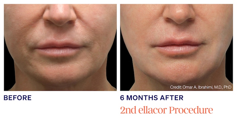 ellacor treatment results lips