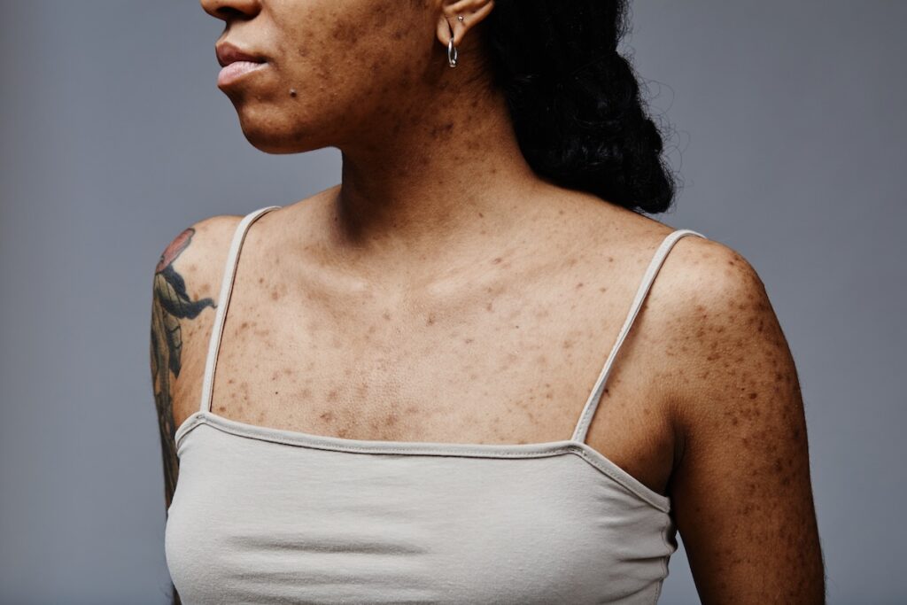 Close-up of a woman's chest with dark spots before she receives hyperpigmentation treatment near Minnetonka
